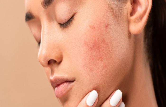 Symptoms of Acne