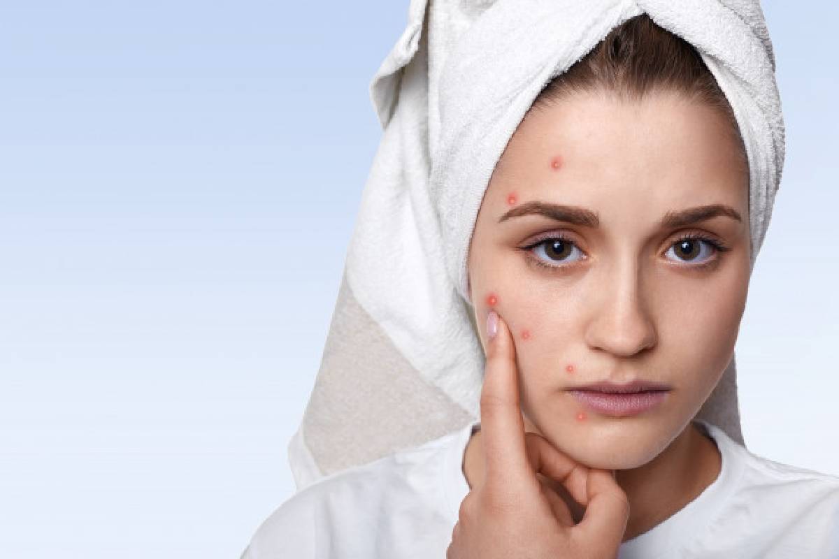 Acne – What Is It, Its Symptoms and Causes