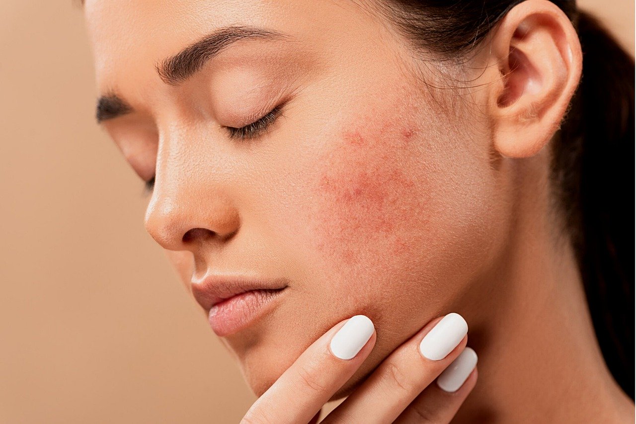 How To Prevent Pimples Caused By Sweating
