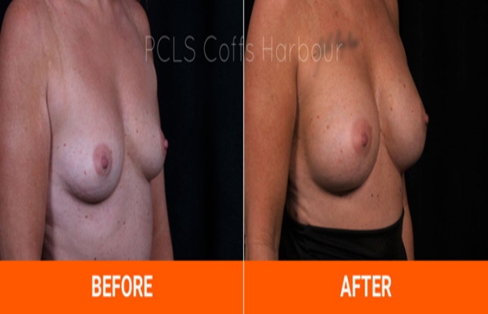 Breast augmentation