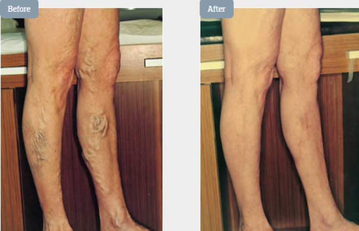 EVLT – Endovenous Laser Treatment