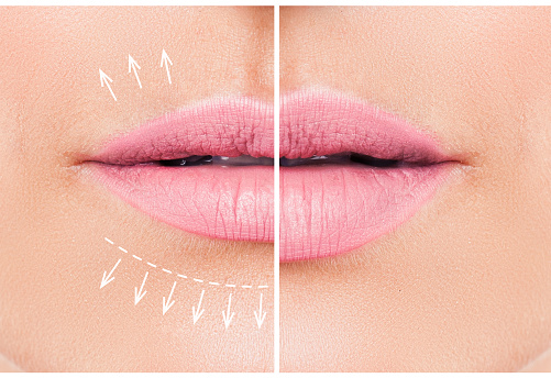 Lip Enhancements Might Be What You’re Looking For