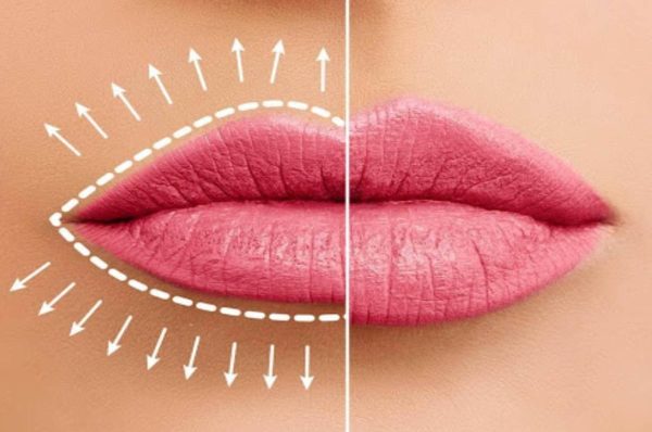 Lip Enhancements Might Be What You're Looking For - 2023