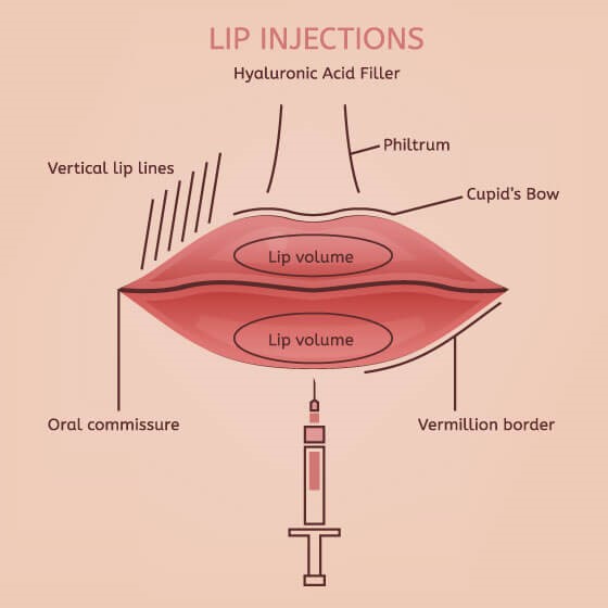 Lip Injections