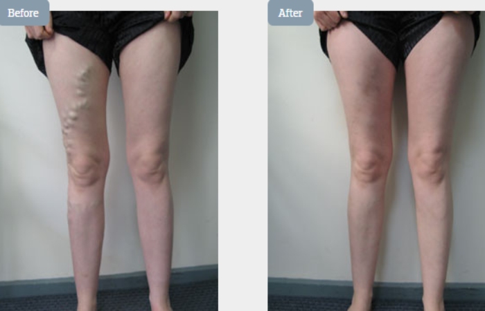 Sclerotherapy