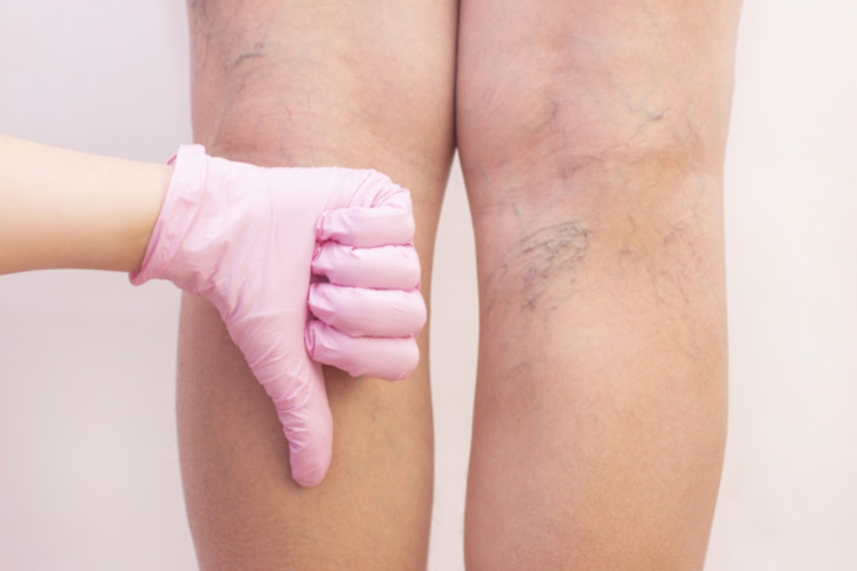 Possible Solutions For Varicose Veins