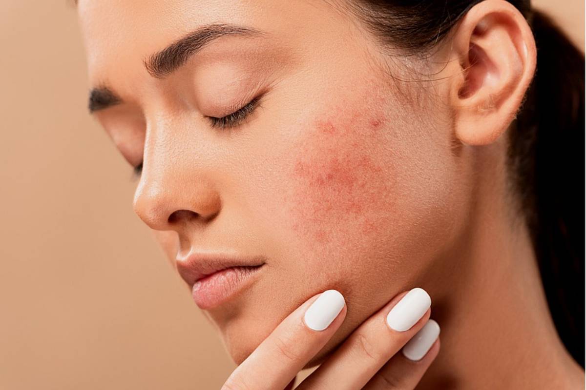 Acne Myths That Prevent You From Getting Clear Skin