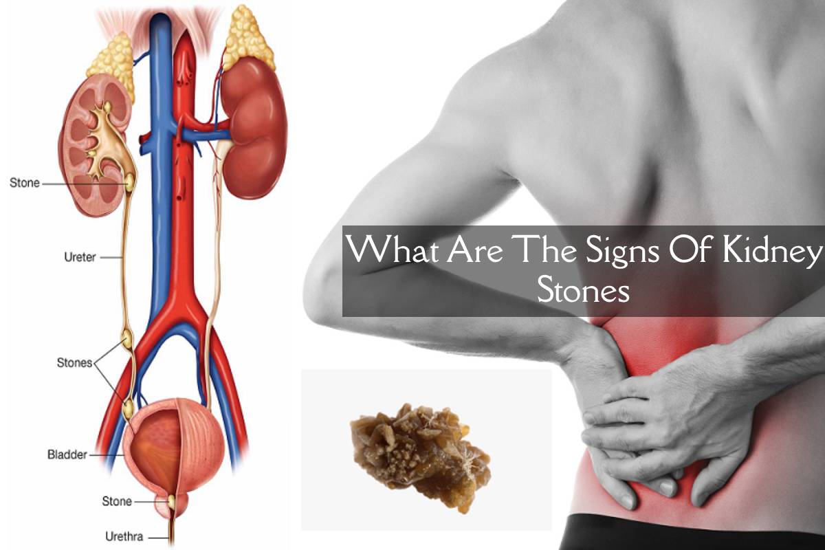 What are the Signs of Kidney Stones? -2024