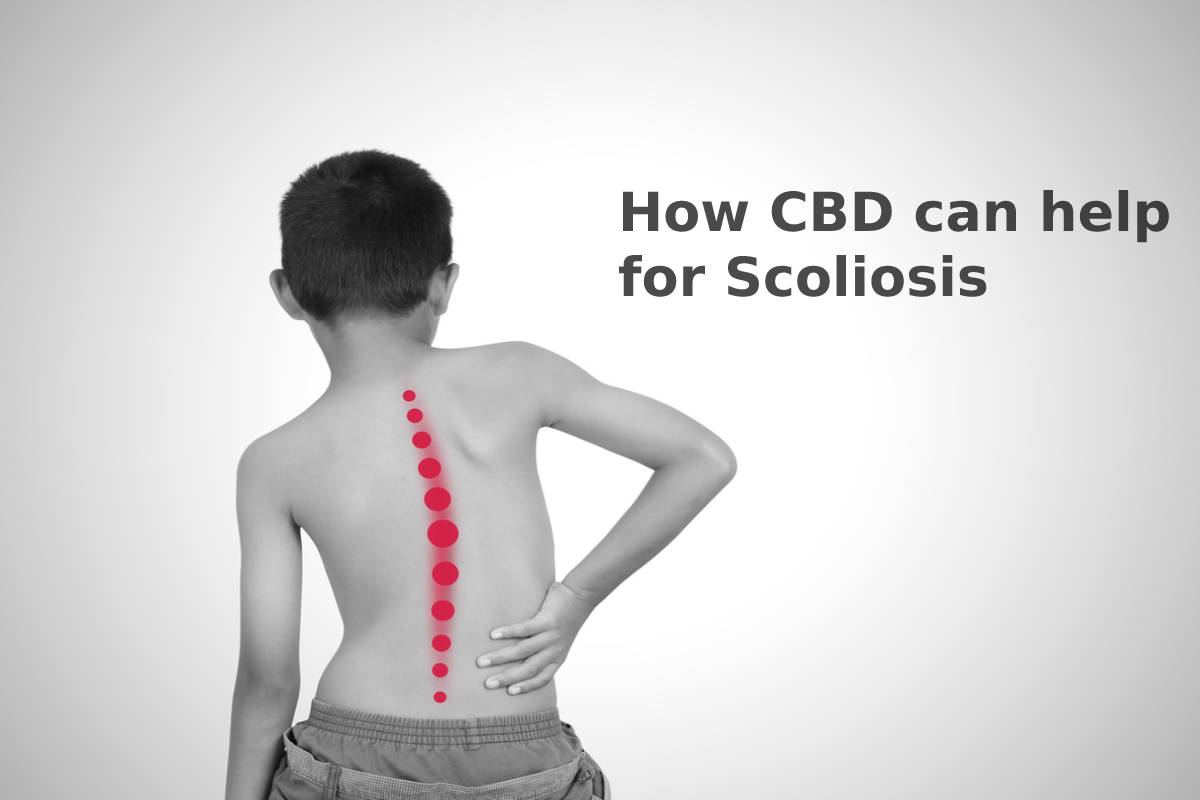 How CBD can help for Scoliosis – 2024