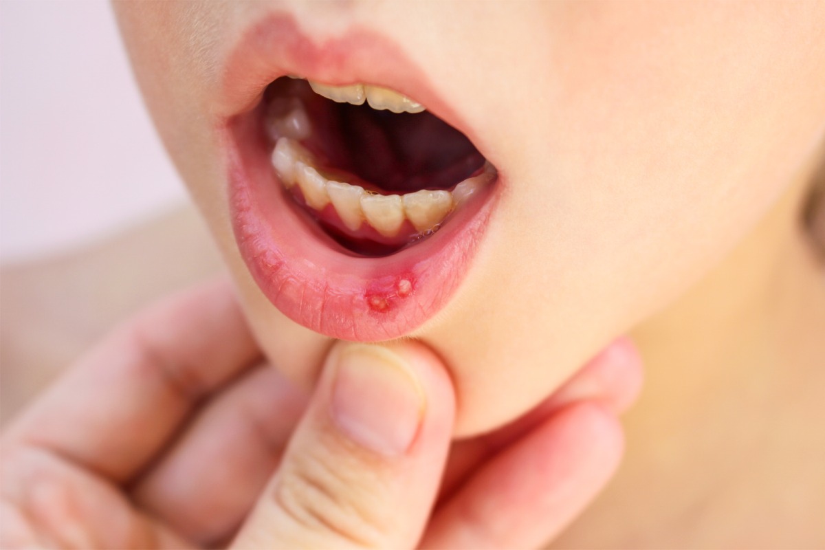 Canker Sores 101 – 2023