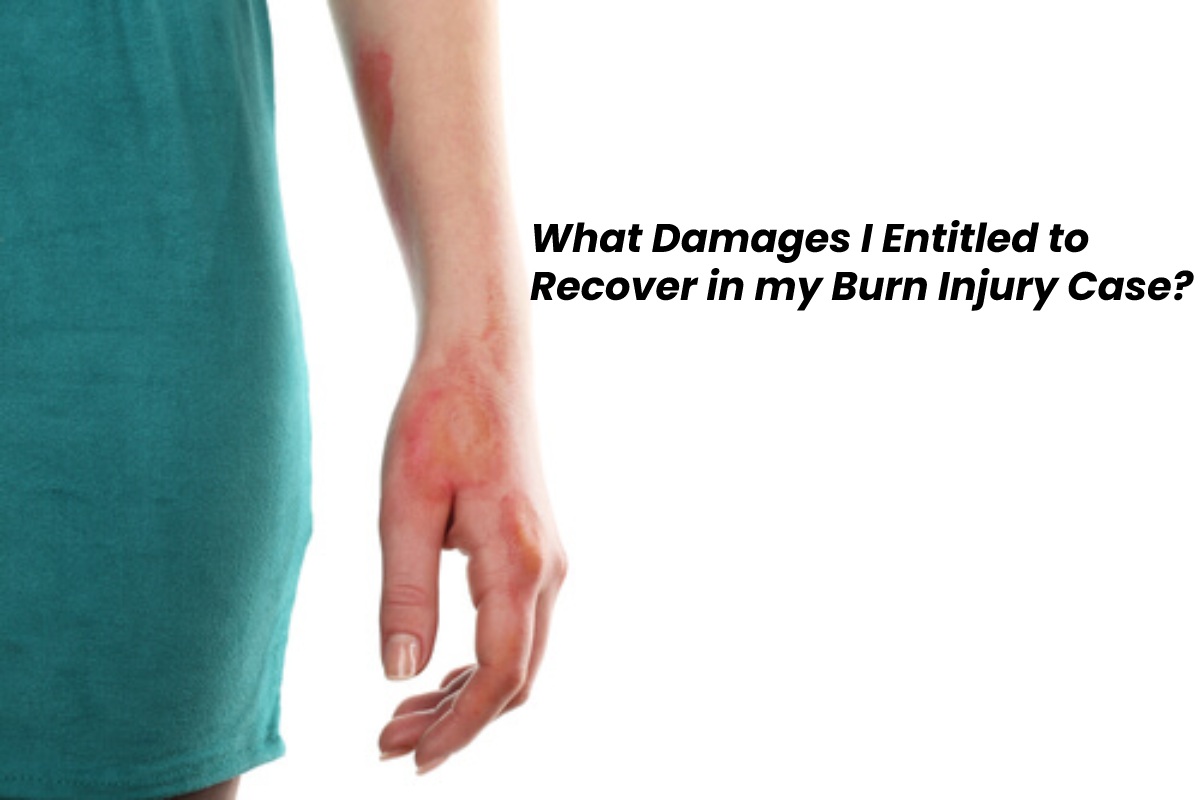 What Damages I Entitled to Recover in my Burn Injury Case?