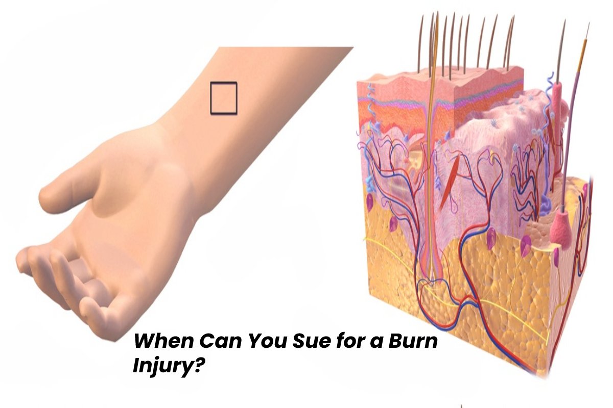 When Can You Sue for a Burn Injury?