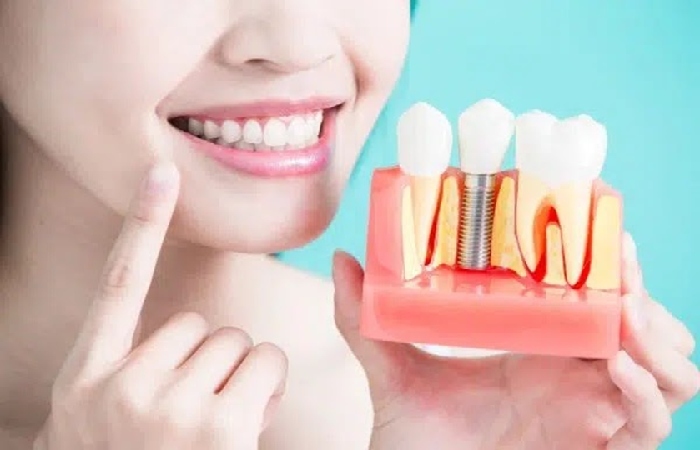 Failure Of Dental Implants At Both The Early And Late Stages 