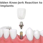 The Hidden Knee-Jerk Reaction to Tooth Implants