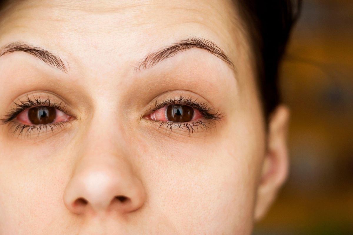 What Do I Need to Know About Conjunctivitis?