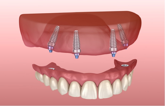 Benefits Of Dental Implants