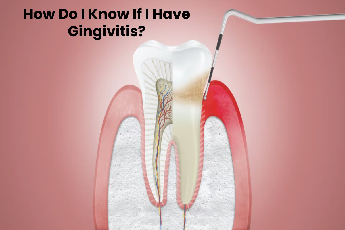 How Do I Know If I Have Gingivitis? – 2024