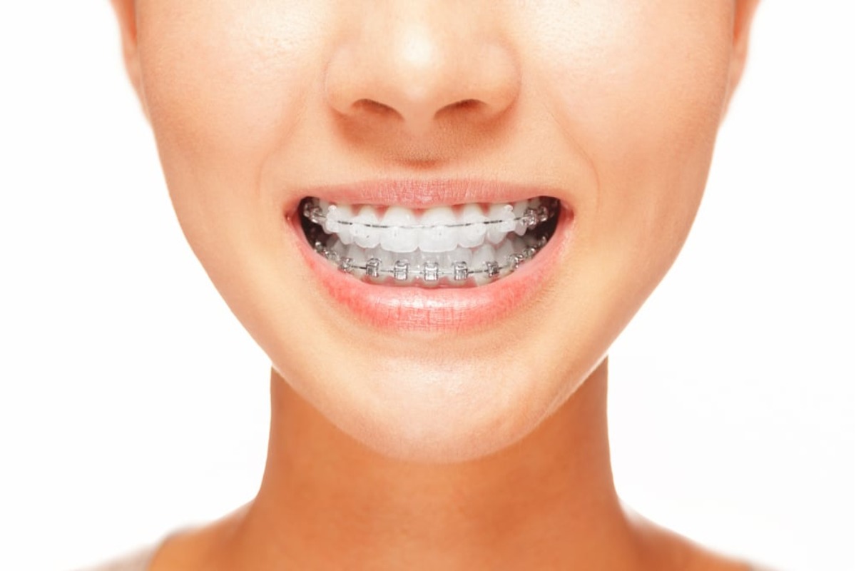 Floss Your Teeth With Braces by Trying These 5 Tips – 2023