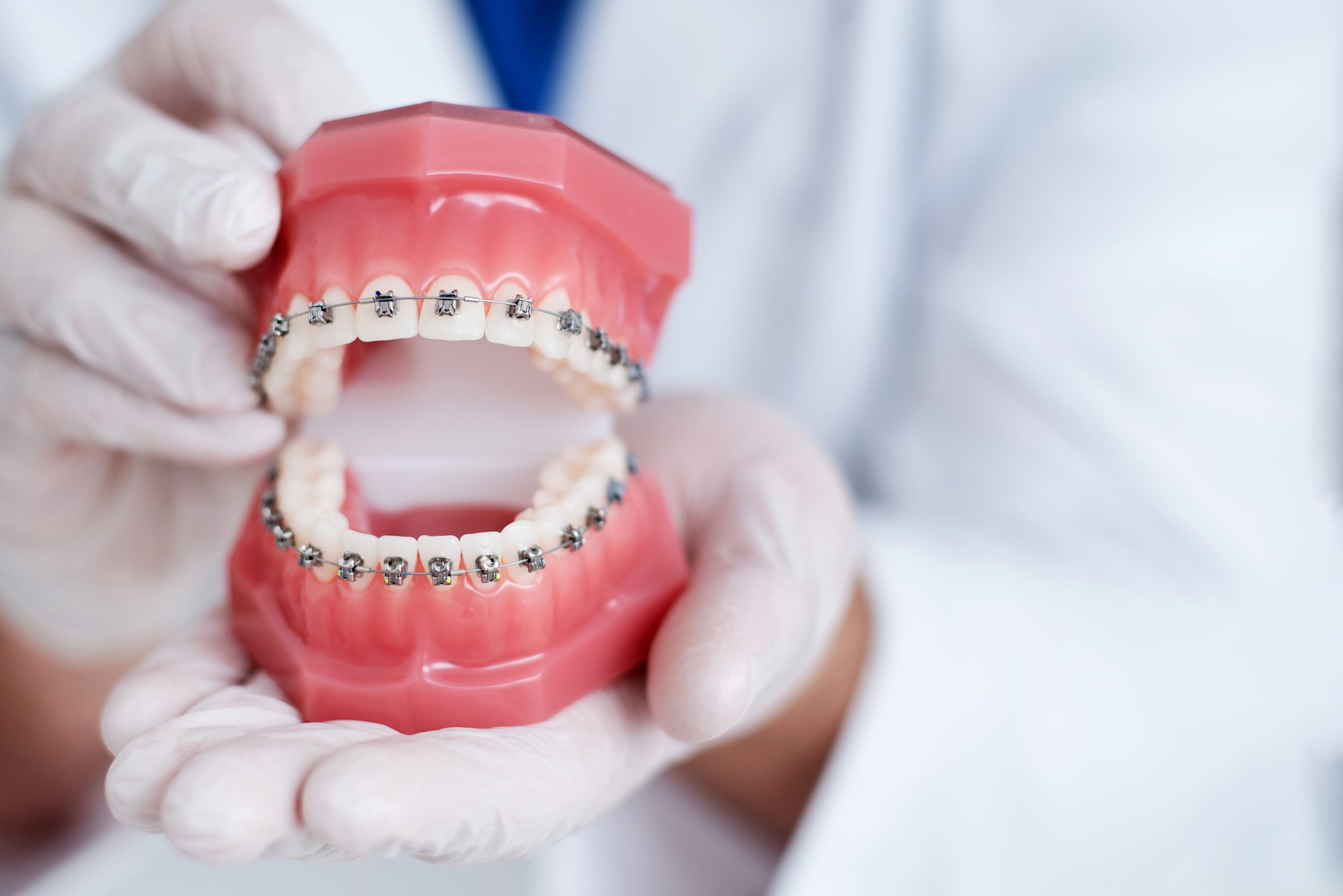 Type Of Braces