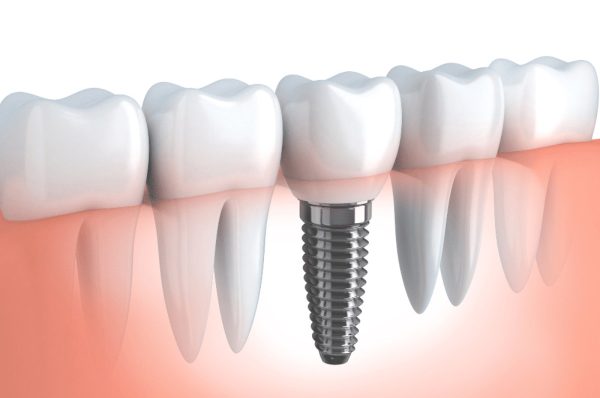 choose the best dental clinic for your dental implants