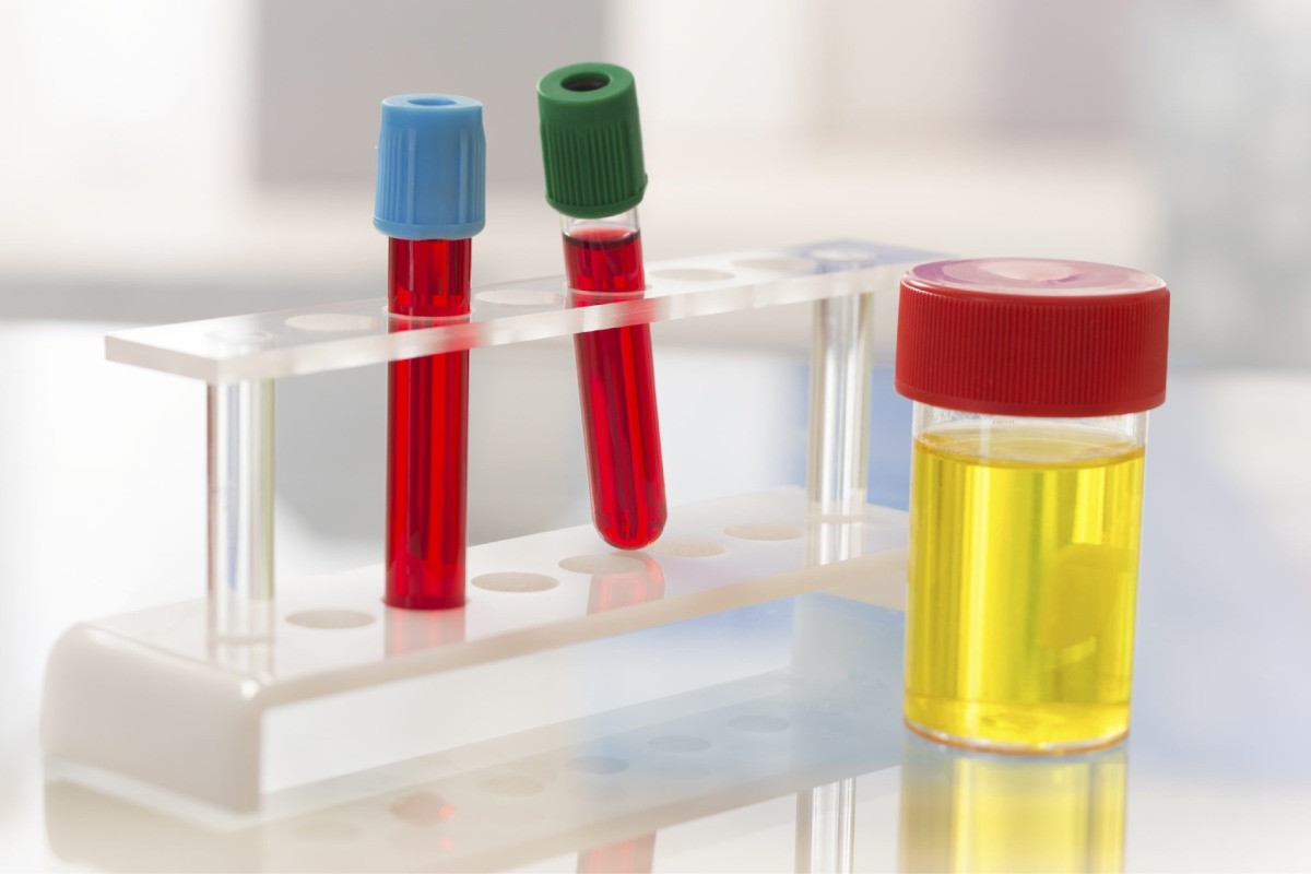 Urine Samples and Blood Testing – 2024
