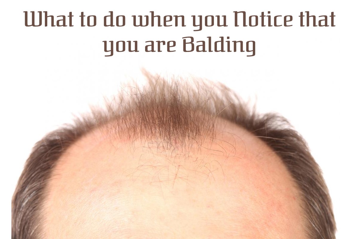 What to do when you notice that you are balding (2024)