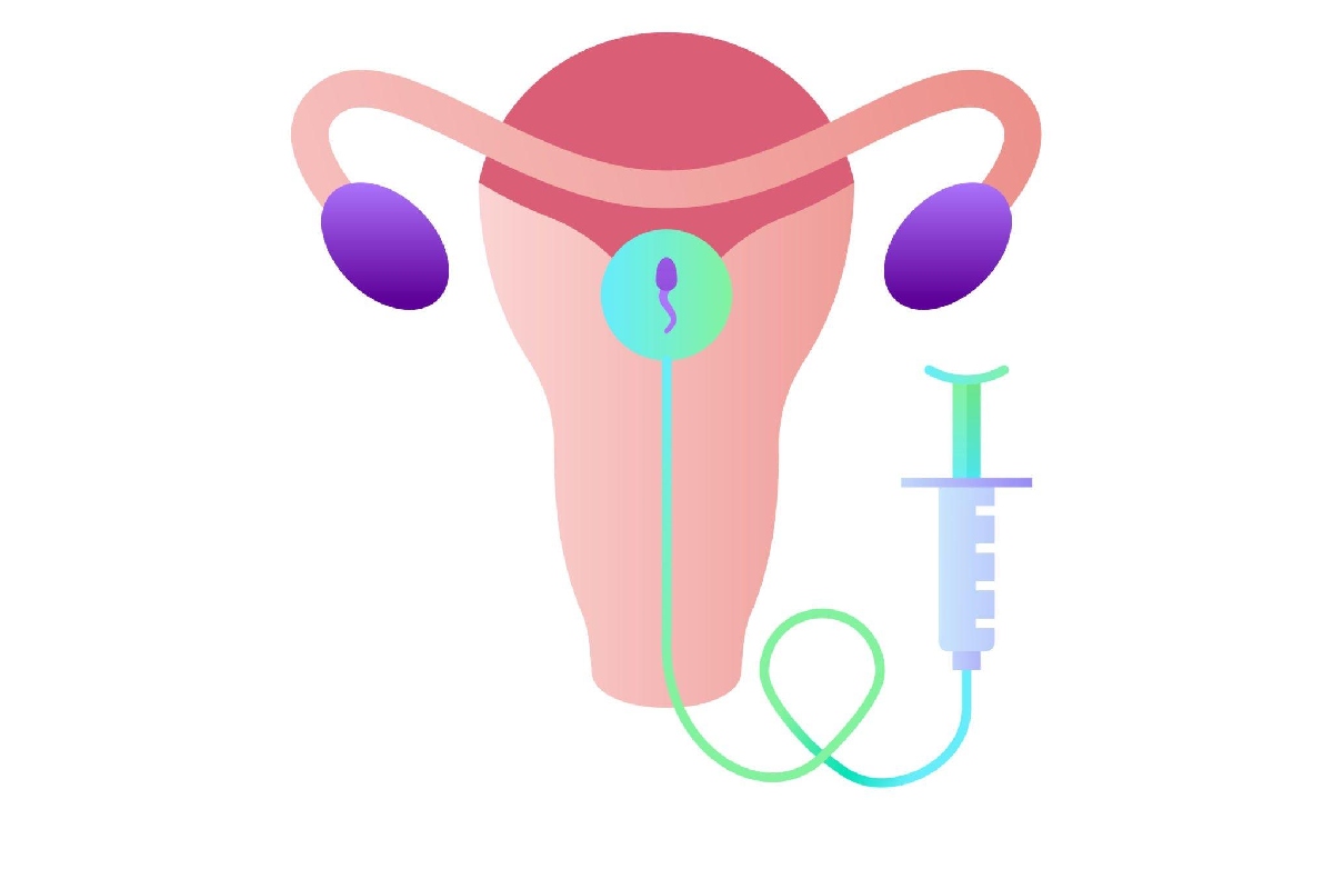 Successful Pregnancy by Intrauterine Insemination – 2023