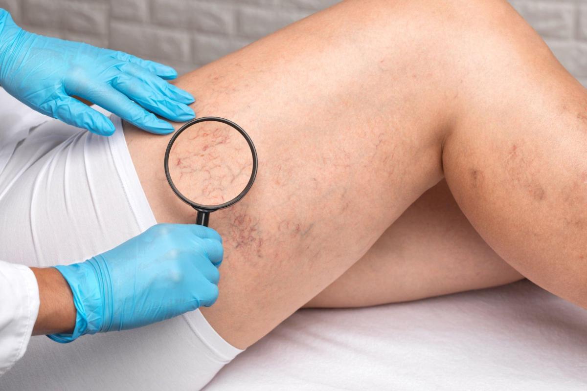 What Increases Your Risk of Developing Spider Veins? – 2023