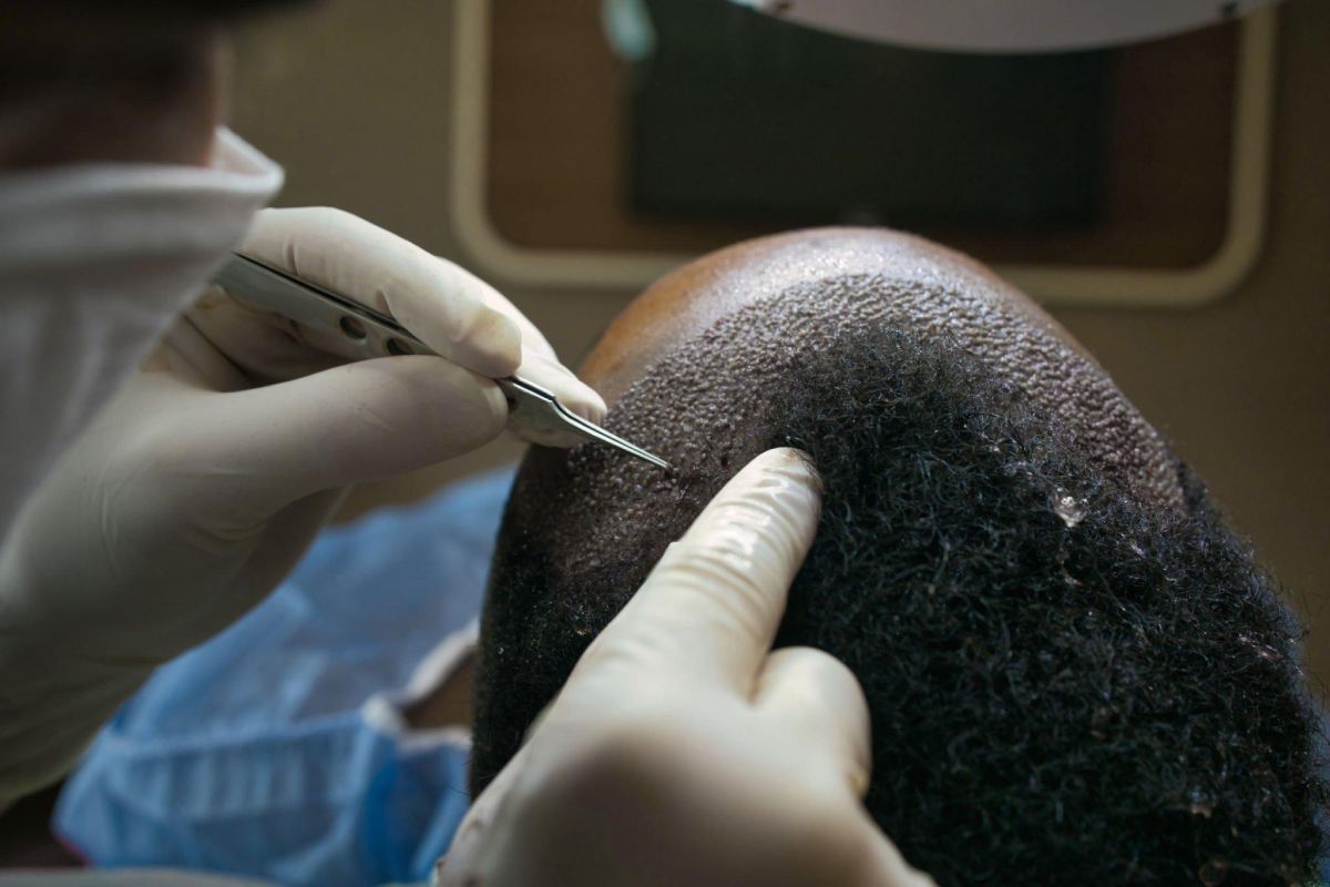 Questions You Should Ask Before A Hair Transplant – 2023
