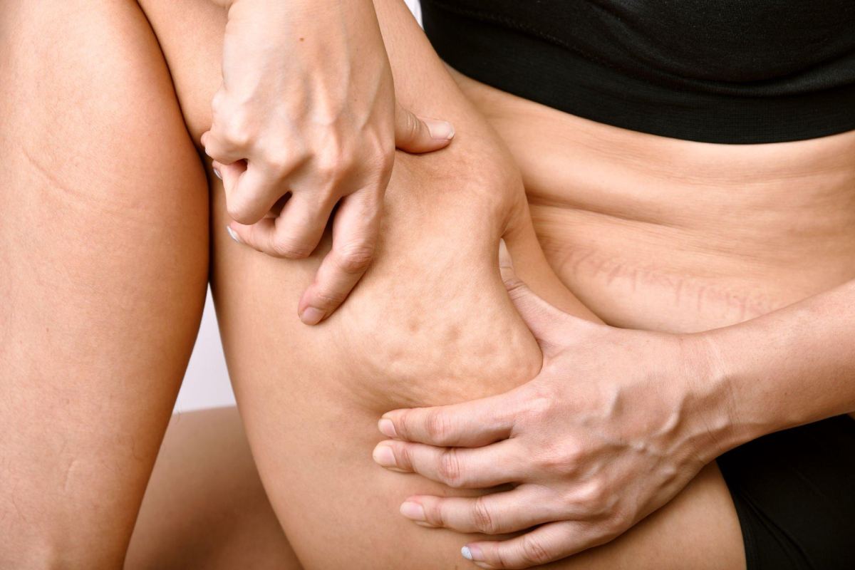 What is Cellulite? Causes, Symptoms, and More – 2024