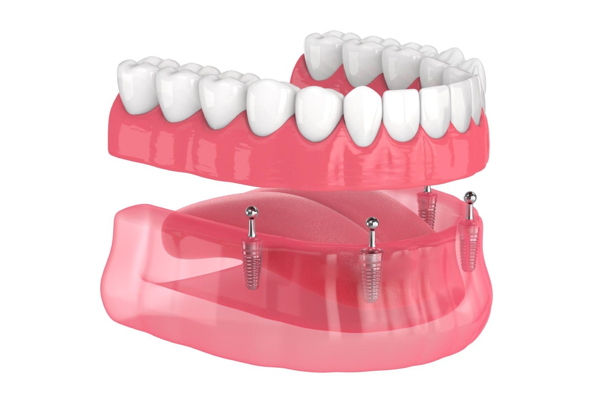 Tips To Keep Your Dentures in a Good Condition