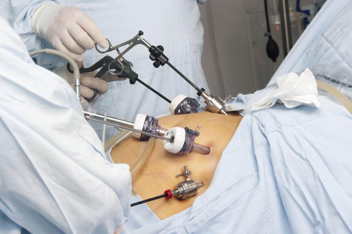 What are the Advantages of Bariatric Surgery? – 2023