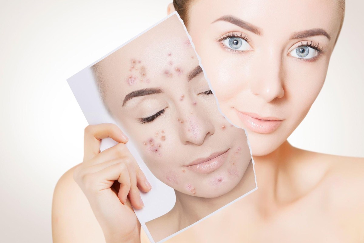 How You Can Prevent And Treat Acne Scars – 2023