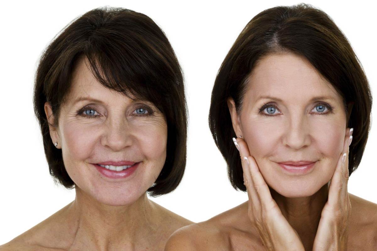 Facelift Vs. Mini Facelift: What’s the Difference?