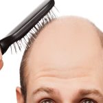 What Are The Early Signs of Balding_