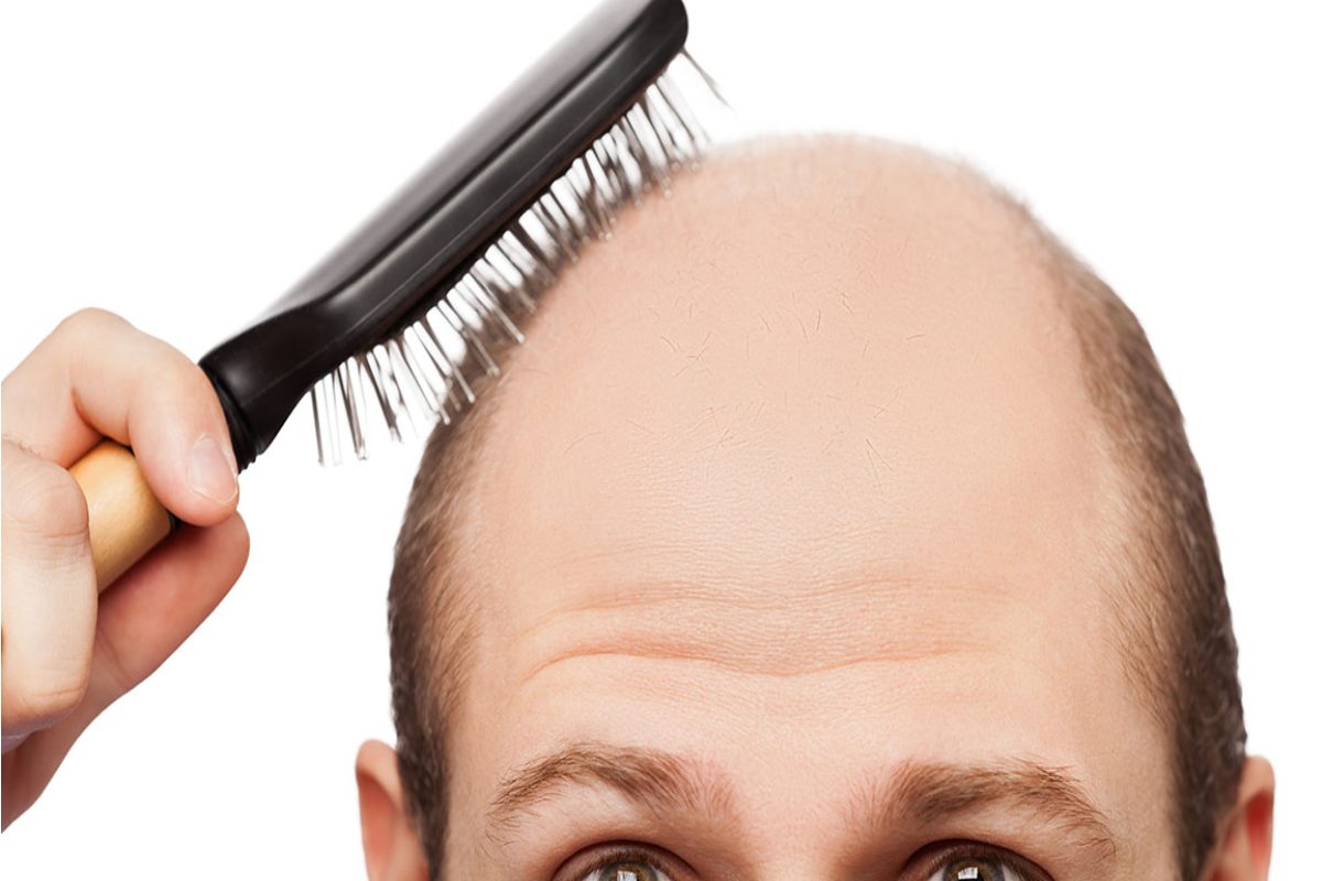 What Are The Early Signs of Balding? – 2023