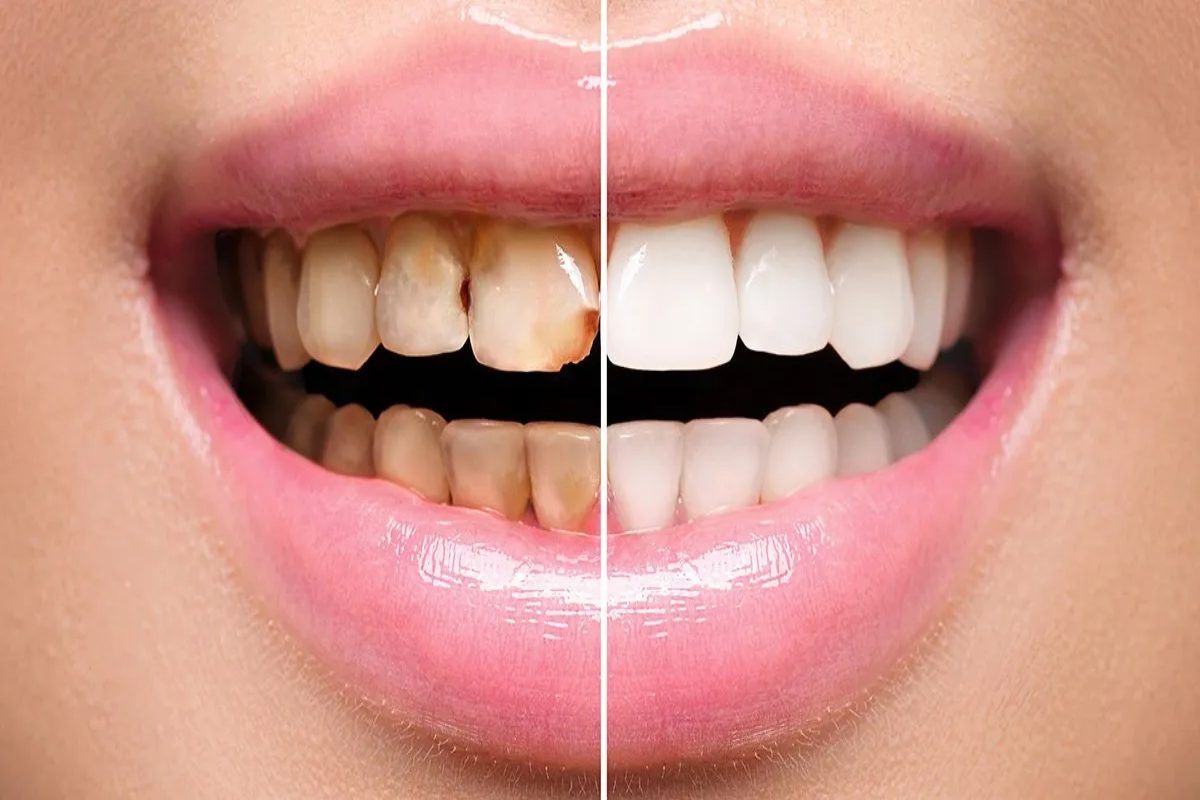 Understanding Cosmetic Veneers