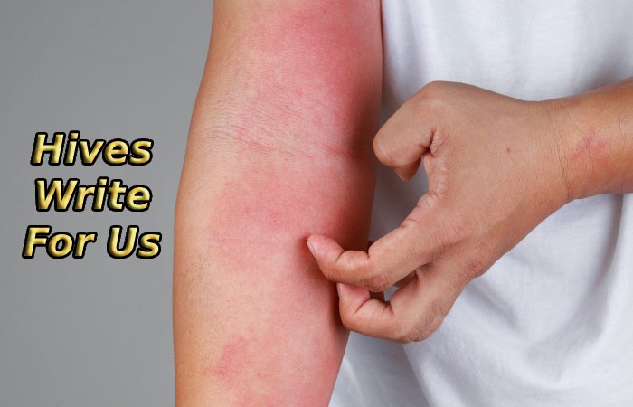 Hives Write For Us