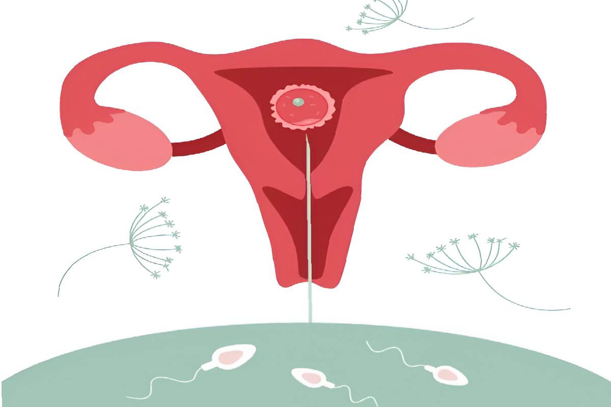 Successful Pregnancy by Intrauterine Insemination