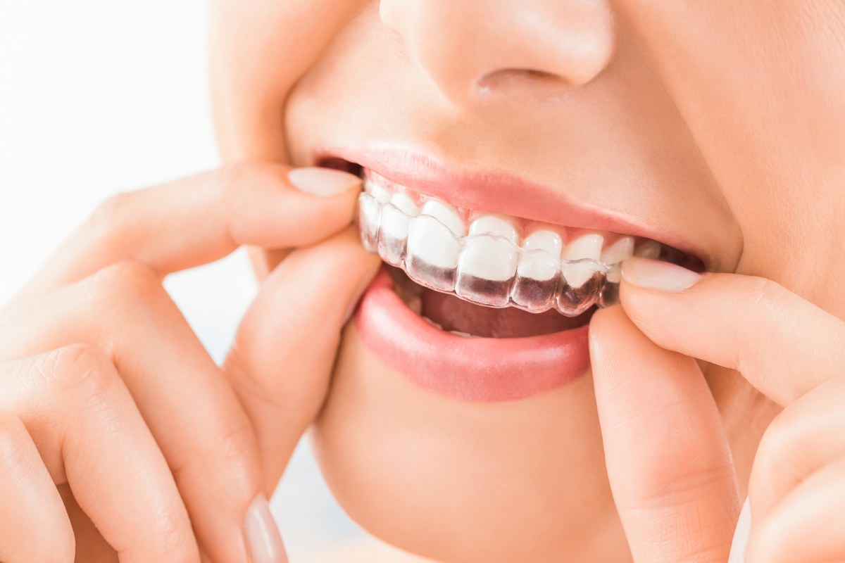 Understanding Invisalign Treatment