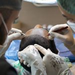 Top Hair Transplant In Turkey- World’s Largest Destination For Hair Transplant Surgery