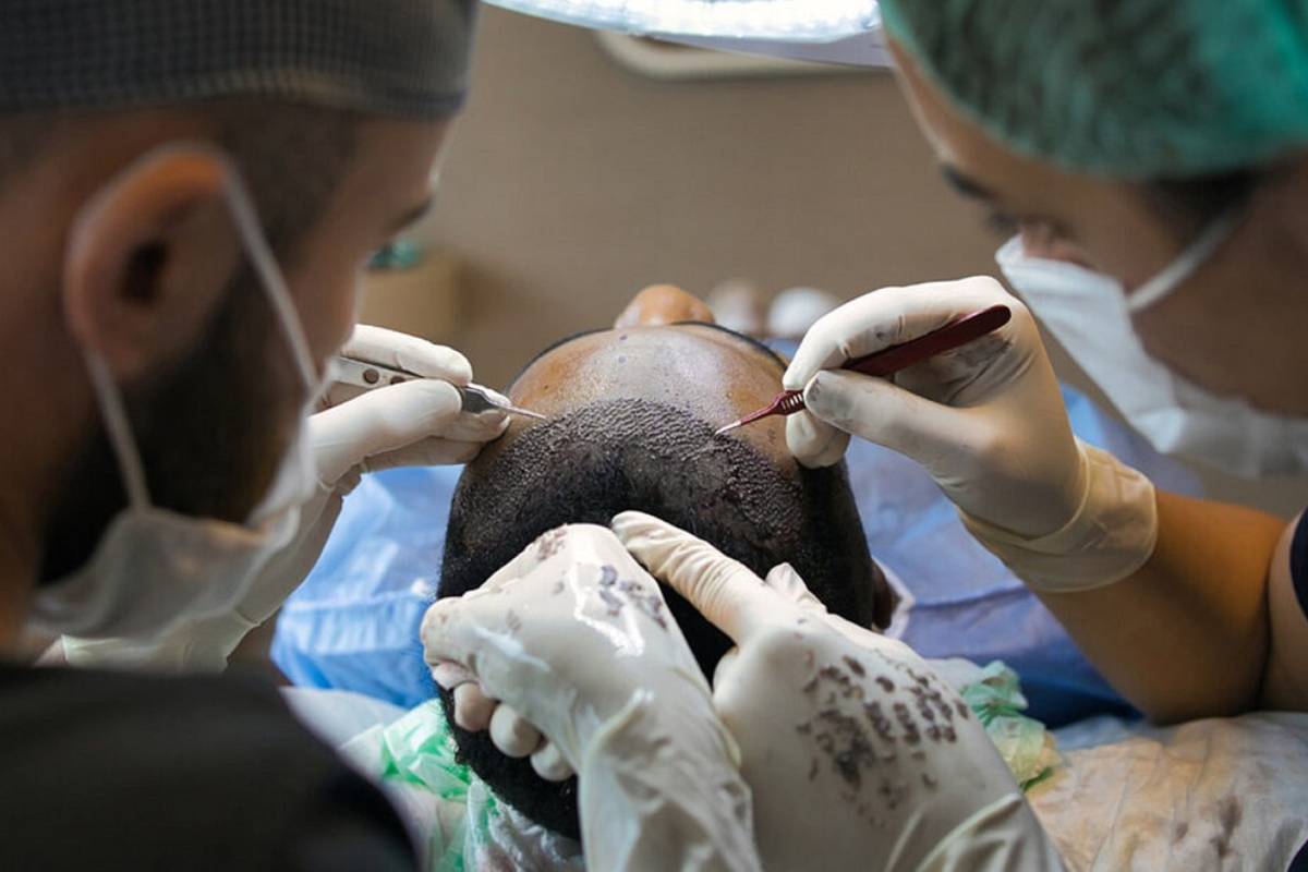Top Hair Transplant In Turkey- World’s Largest Destination For Hair Transplant Surgery