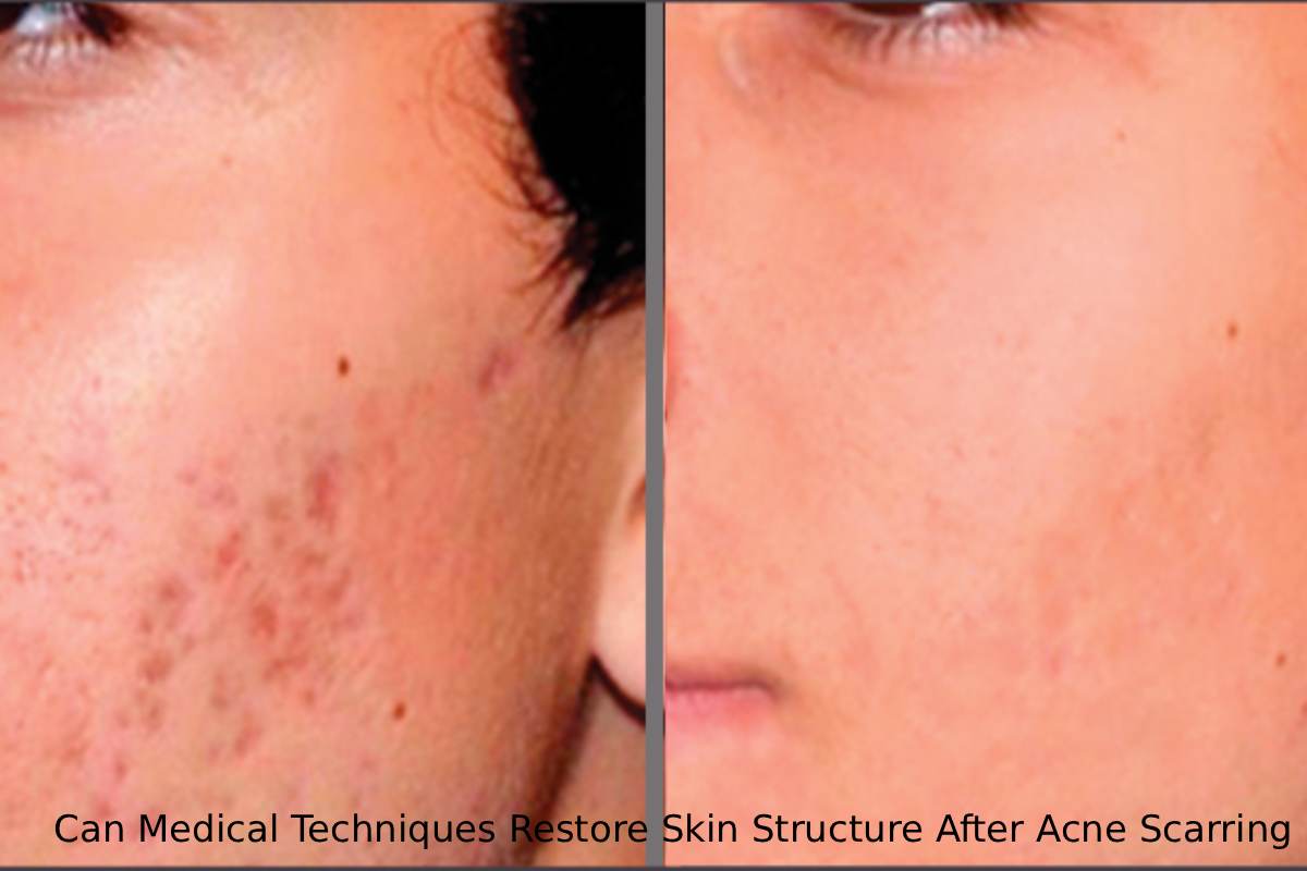 Medical Techniques Restore Skin Structure After Acne Scarring